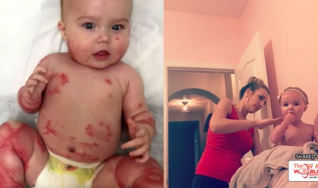 Strangers Fear Baby’s Skin Condition – Mom Teaches Them A Lesson With ‘Simple’ Solution