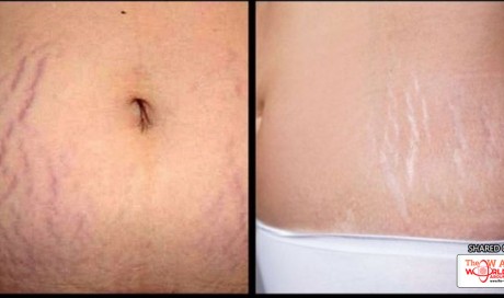 Do You Know the Difference Between Purple Stretch Marks and White Stretch Marks?