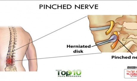 Home Remedies for a Pinched Nerve
