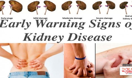 Warning: Don’t Ignore the 4 KIDNEY Damage Symptoms!