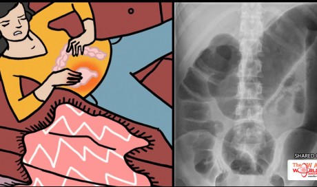 Toxic Megacolon: 6 Alarming Signs And Symptoms Of This Life-Threatening Condition