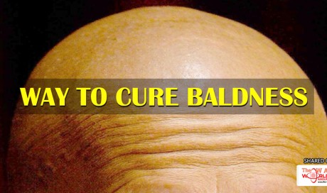 Scientists Think They've Found A Way To Cure Baldness