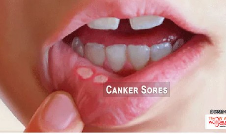 6 Natural Home Remedies for Canker Sores