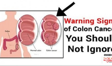 The 10 dangerous sings of colon cancer you shouldn’t ignore