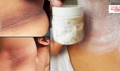 Remove Those Annoying Patches On The Neck, Underarms and Inner Thighs in 15 Minutes or Less