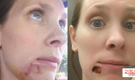 Woman Finds A Hole In Her Face, Then Finds Out It’s Life-Threatening