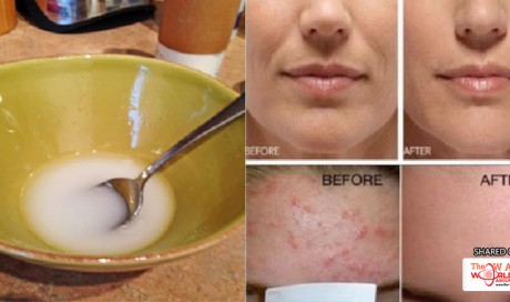 Get Rid of Acne and Pimples, Alleviate Sunburn and Improve Complexion with THIS Homemade Skin Care Product!