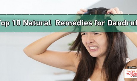 Top 10 Natural Remedies for Dandruff