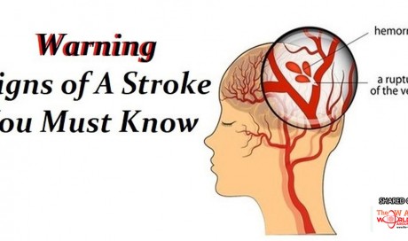 The Dangerous warning signs of a stroke that we should know