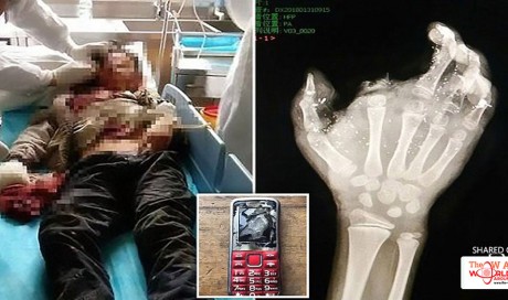 Boy, 12, gets his finger BLOWN OFF and is blinded in one eye after his phone exploded while charging 