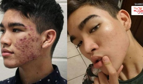 Teen Cures His Severe Acne with a Budget Skin Routine and This is how He did it