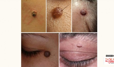How to Get Rid of Skin Moles Naturally at Home