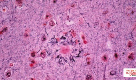 Scientists Explore Ties Between Alzheimer's And Brain's Ancient Immune System