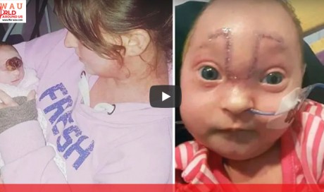 Baby Girl Born With Brain Outside Her Skull Is Declared A “Little Miracle”