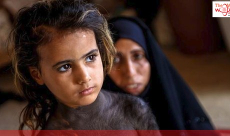 Rare congenital skin disease turns little Iraqi girl into a social outcast
