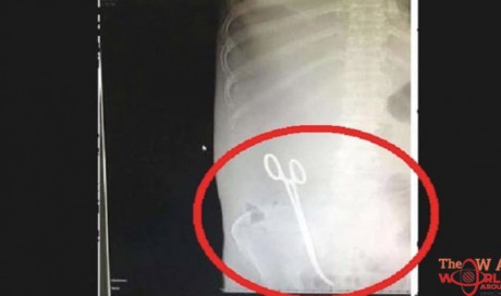 Egyptian doctor leaves scissor in stomach after operation in Hail, Saudi Arabia