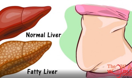 6 Clear Warning Signs Your Liver Is Full Of Toxins And Making You Fat (How to Stop it)