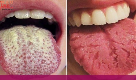 12 Warning Signs Your Tongue May Be Sending About Your Health
