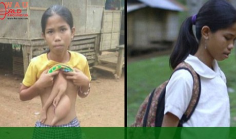 14-year-old Filipina has 'twin' sister growing from her chest
