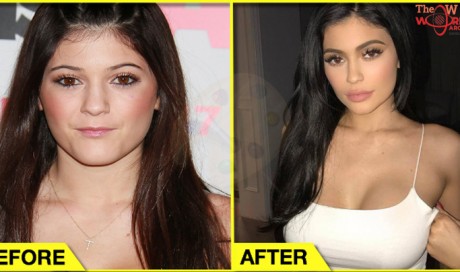 10 Celebrities Who Confessed That They Had Plastic Surgery