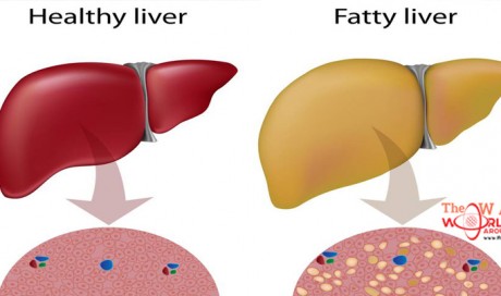 1 in 5 People Unknowingly Have Fatty Liver Disease, Here Are The 10 Natural Remedies You Need to Know