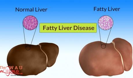 Fatty Liver Disease: 6 Symptoms You Need to Know