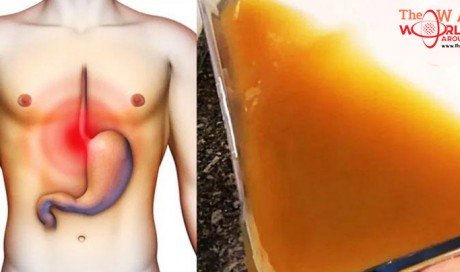 Treat Stomach Ulcers, Acid Reflux and Gastritis with 1 Ingredient