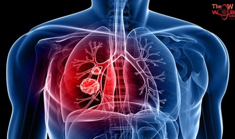 How to Reduce Lung Cancer Deaths Right Now