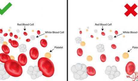 5 Signs You Have A Low Red Blood Cell Count
