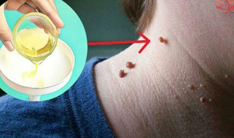 How To Remove Fibroma And Other Skin Warts All By Yourself?