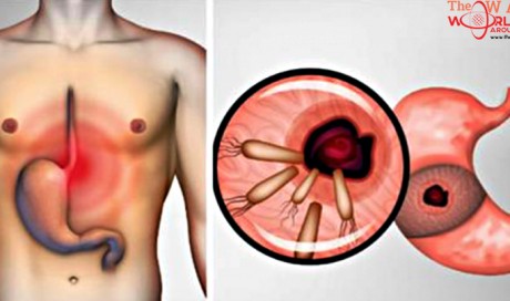 Here is How to Kill the Bacteria that Causes Heartburn and Bloating