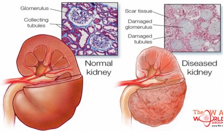 Signs, Symptoms and Best Remedies for Kidney Failure