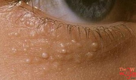 Here's Why Some People Have Those Weird White Bumps Around Their Eyes