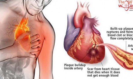Change These 5 Habits and Prevent 80% of Heart Attacks