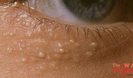 Here's Why Some People Have Those Weird White Bumps Around Their Eyes