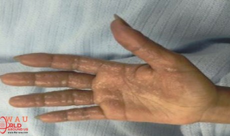Expat Suffers Burns Using Hair Dye Without Gloves