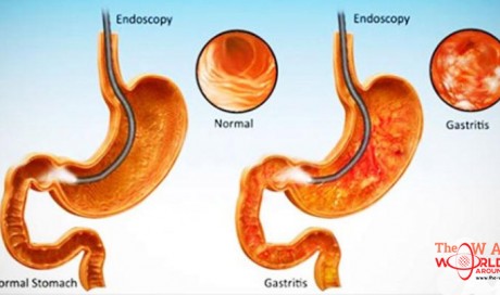 8 Things To Avoid When Suffering From Gastritis