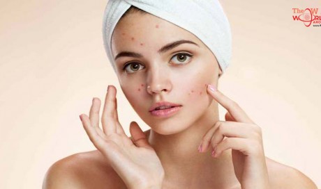 10 Easy and Natural Ways to Get Rid of Acne