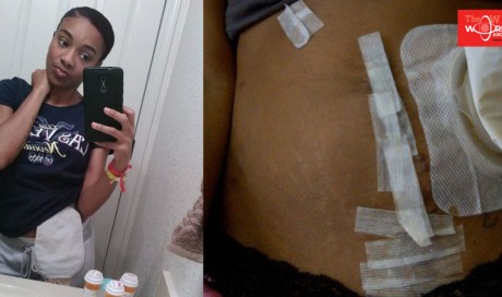 Bouncer ripped off woman's stoma bag because 'they thought it was a threat'
