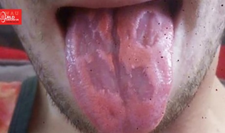 Horrific photo shows teacher’s tongue ‘EATEN AWAY’ after downing six energy drinks a day