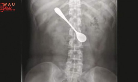 Woman swallows metal spoon, stays in body for days