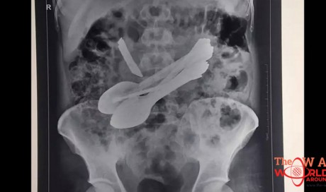 Indian mans stomach x-ray shocks doctors rushed to surgery