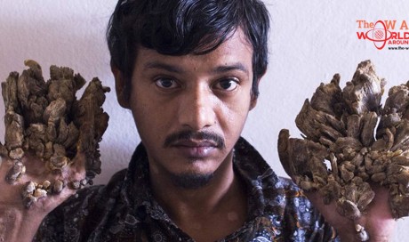 Bangladesh 'Tree Man' wants hands amputated