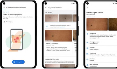 Google AI tool can help patients identify skin conditions